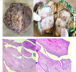 Figure 2. (A) Gross picture of left breast lump measuring 17x10x4 cm. (B) Cut section of breast lump showing well circumscribed grey white areas with cleft like spaces and cystic areas. Margins inked with green) are free grossly. (C) (D) &E stained section at 200x and 400x respectively showing stromal proliferation with mild atypia in a leaf-like pattern capped by benign ductal epithelium and intact myoepithelial layer.